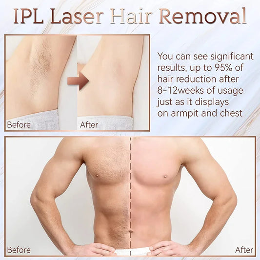 SmoothSkin™ IPL Hair Removal – 999,999 Flashes Laser Epilator for Women